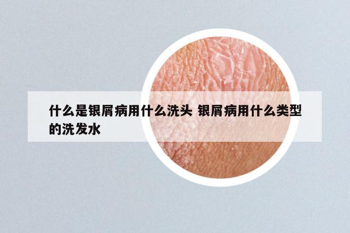 什么是银屑病用什么洗头 银屑病用什么类型的洗发水