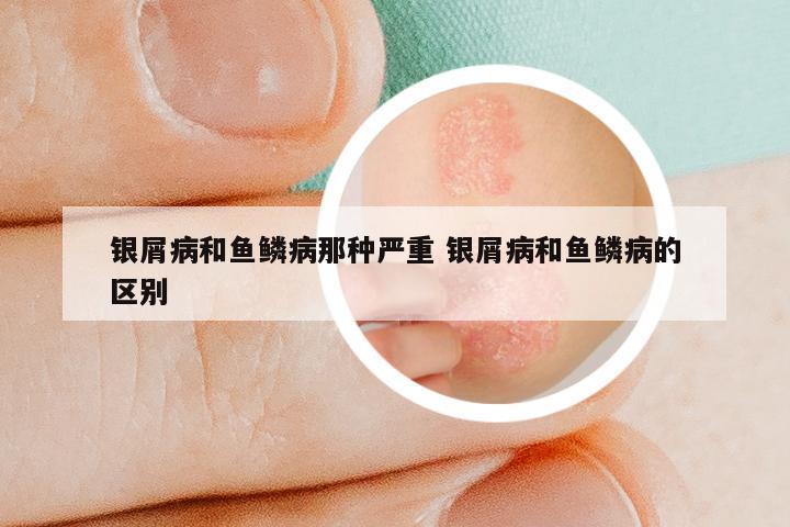 银屑病和鱼鳞病那种严重 银屑病和鱼鳞病的区别