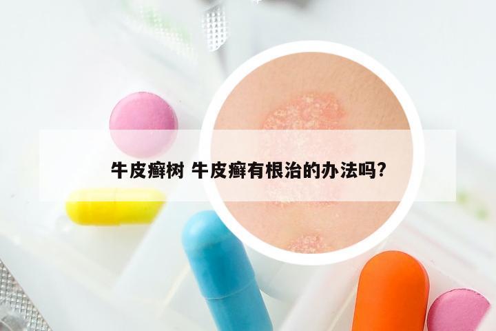 牛皮癣树 牛皮癣有根治的办法吗?