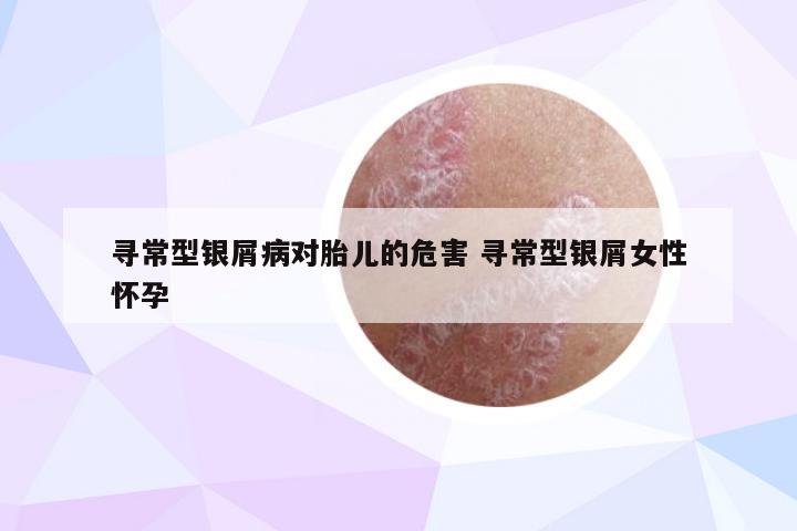 寻常型银屑病对胎儿的危害 寻常型银屑女性怀孕