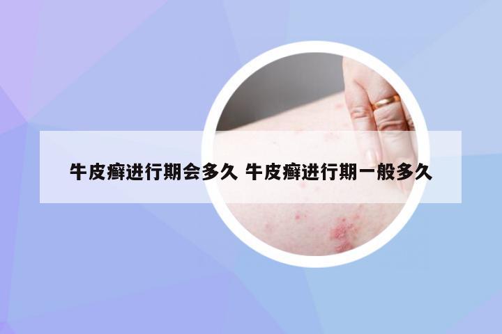 牛皮癣进行期会多久 牛皮癣进行期一般多久