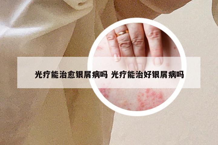 光疗能治愈银屑病吗 光疗能治好银屑病吗
