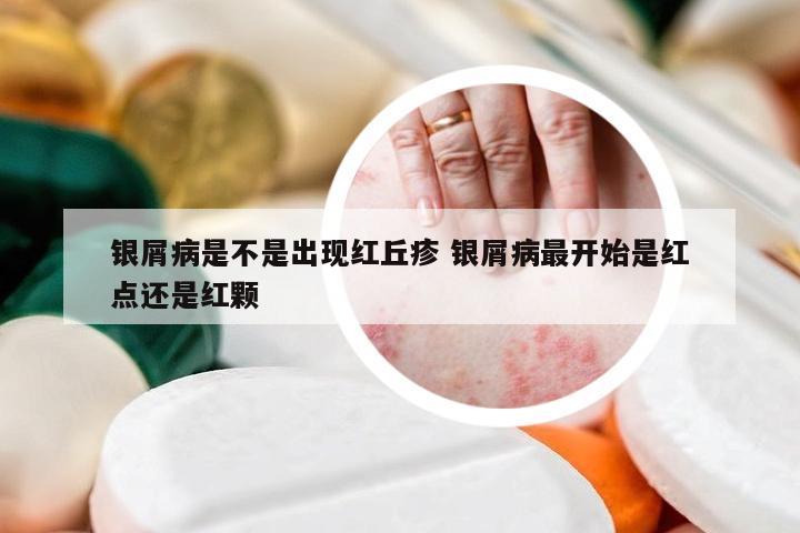 银屑病是不是出现红丘疹 银屑病最开始是红点还是红颗