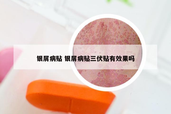 银屑病贴 银屑病贴三伏贴有效果吗