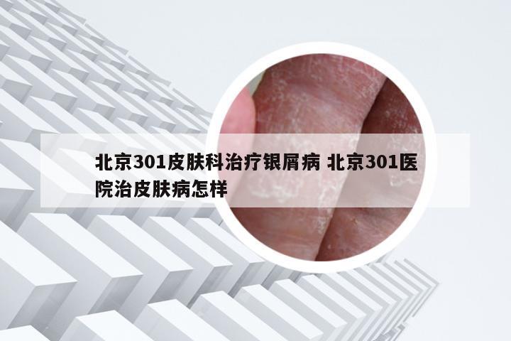 北京301皮肤科治疗银屑病 北京301医院治皮肤病怎样