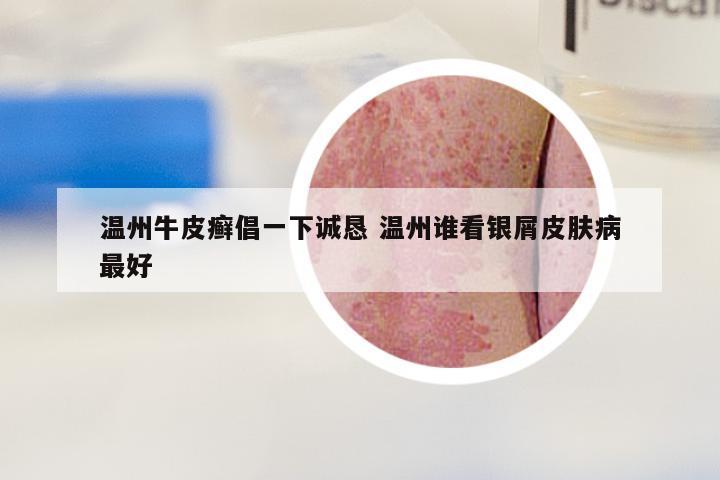 温州牛皮癣倡一下诚恳 温州谁看银屑皮肤病最好