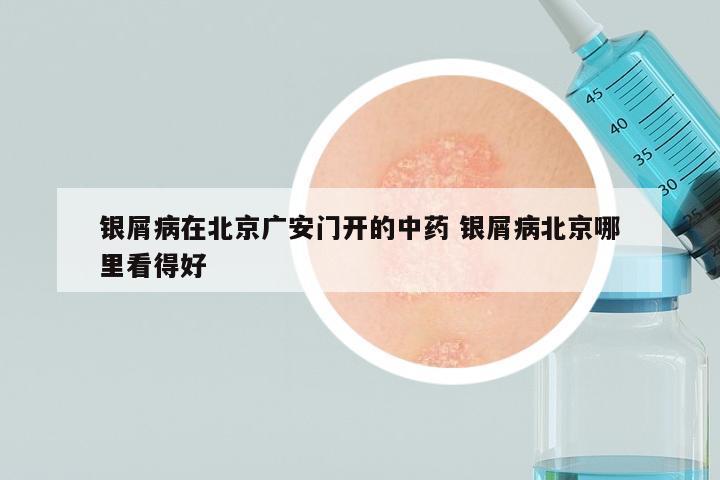 银屑病在北京广安门开的中药 银屑病北京哪里看得好