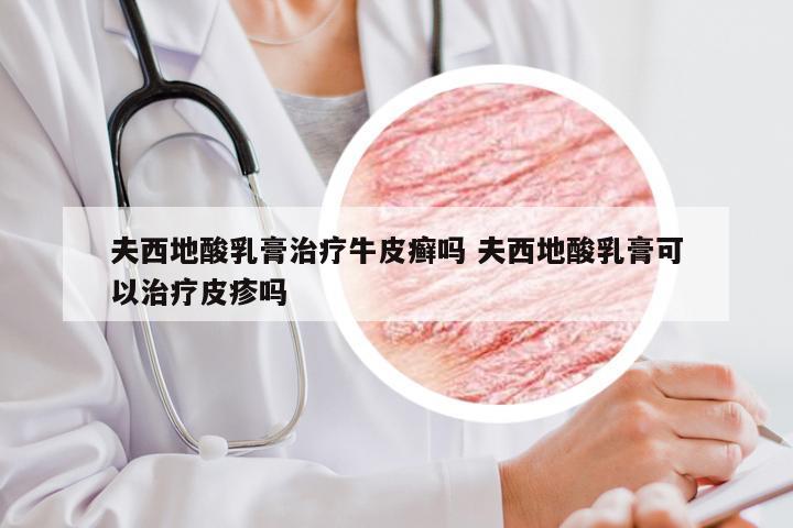 夫西地酸乳膏治疗牛皮癣吗 夫西地酸乳膏可以治疗皮疹吗