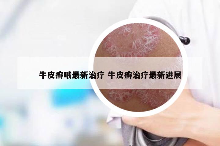 牛皮癣哦最新治疗 牛皮癣治疗最新进展