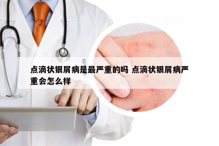 点滴状银屑病是最严重的吗 点滴状银屑病严重会怎么样