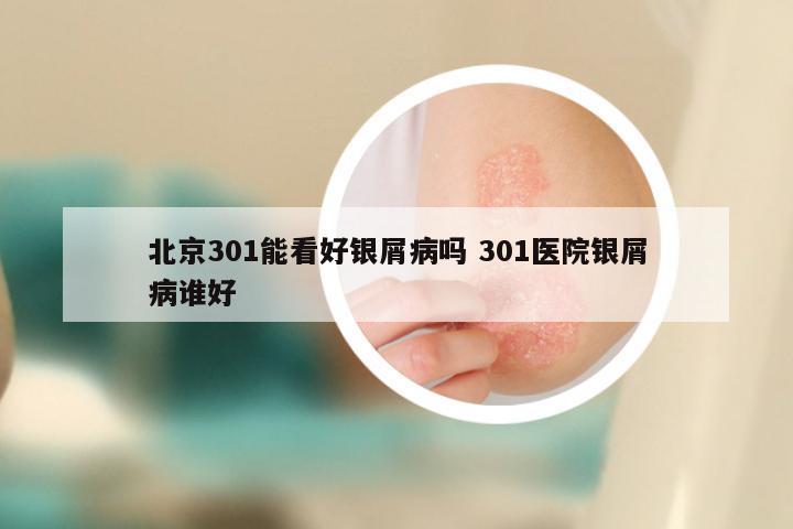 北京301能看好银屑病吗 301医院银屑病谁好