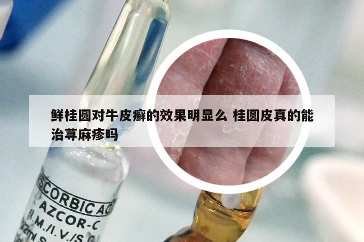 鲜桂圆对牛皮癣的效果明显么 桂圆皮真的能治荨麻疹吗