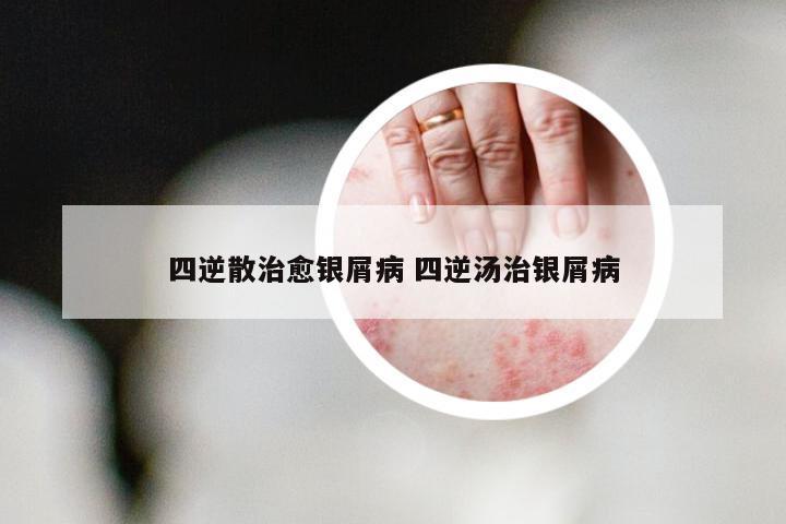 四逆散治愈银屑病 四逆汤治银屑病
