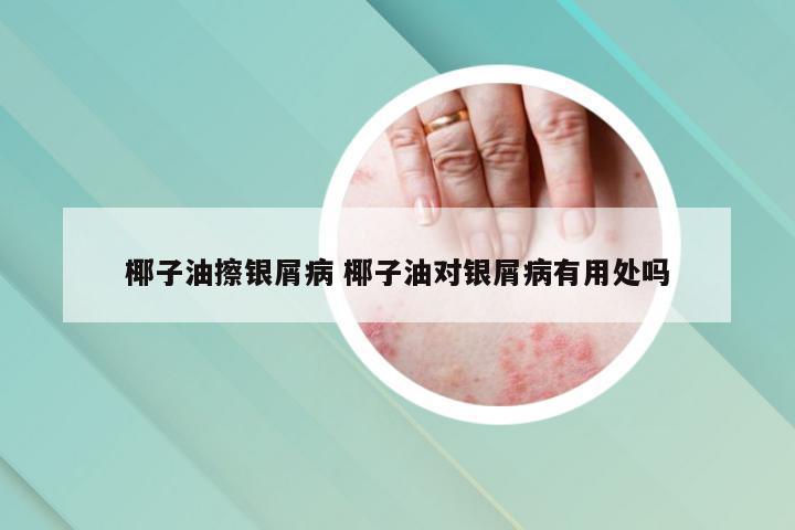 椰子油擦银屑病 椰子油对银屑病有用处吗
