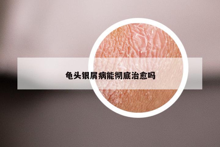 龟头银屑病能彻底治愈吗