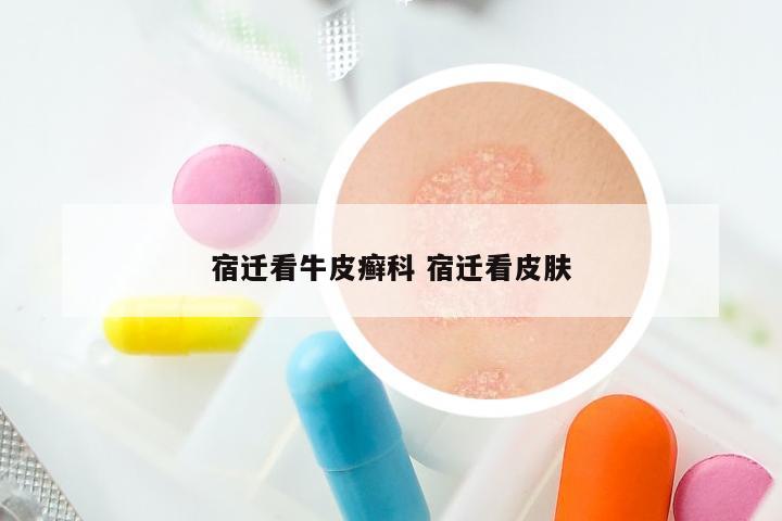 宿迁看牛皮癣科 宿迁看皮肤