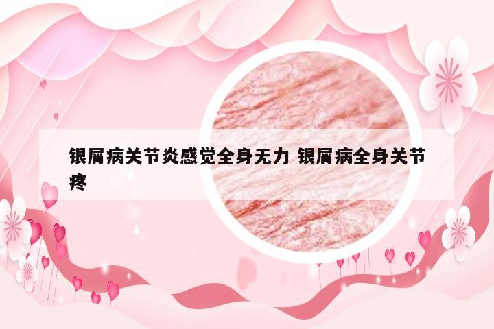 银屑病关节炎感觉全身无力 银屑病全身关节疼