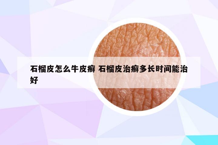 石榴皮怎么牛皮癣 石榴皮治癣多长时间能治好