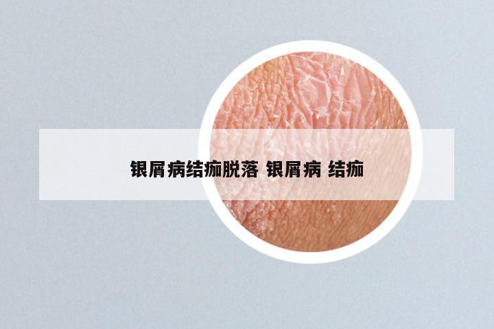 银屑病结痂脱落 银屑病 结痂