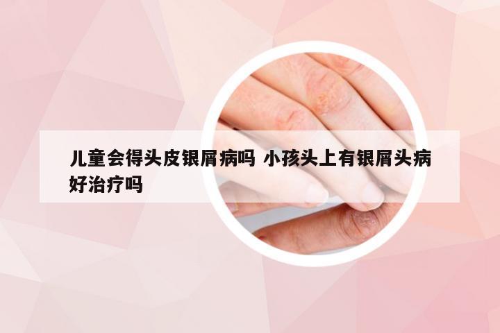 儿童会得头皮银屑病吗 小孩头上有银屑头病好治疗吗