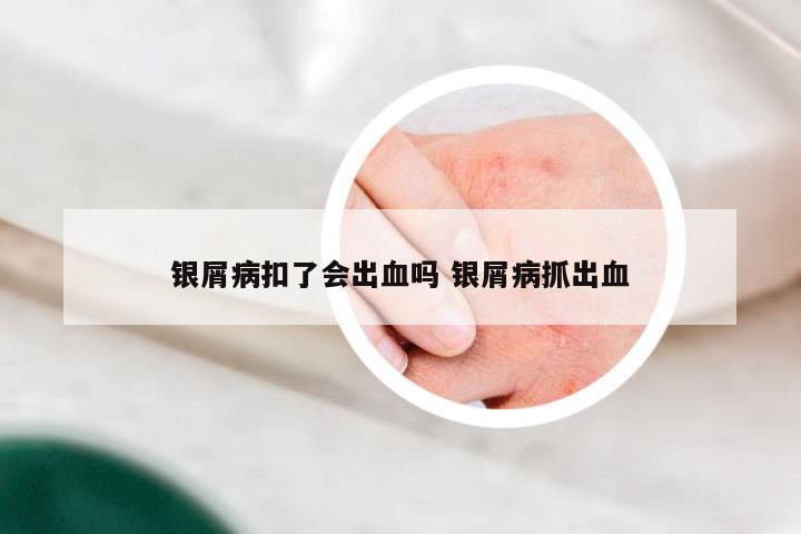 银屑病扣了会出血吗 银屑病抓出血
