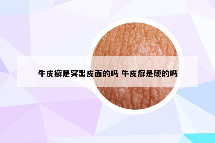牛皮癣是突出皮面的吗 牛皮癣是硬的吗