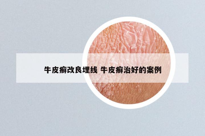 牛皮癣改良埋线 牛皮癣治好的案例