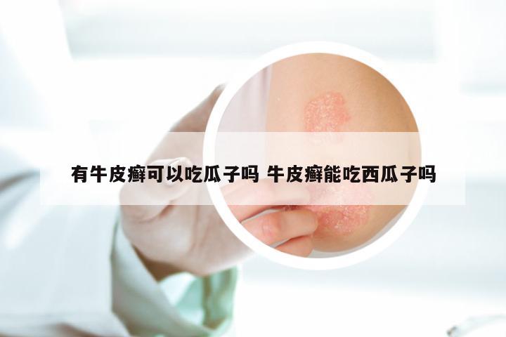 有牛皮癣可以吃瓜子吗 牛皮癣能吃西瓜子吗