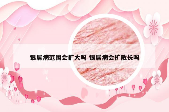 银屑病范围会扩大吗 银屑病会扩散长吗
