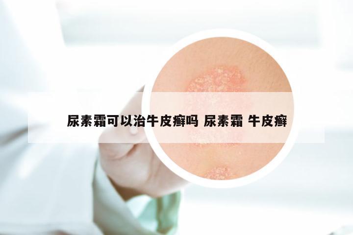 尿素霜可以治牛皮癣吗 尿素霜 牛皮癣