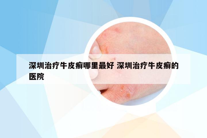 深圳治疗牛皮癣哪里最好 深圳治疗牛皮癣的医院