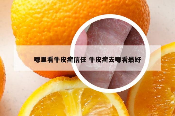 哪里看牛皮癣信任 牛皮癣去哪看最好