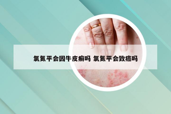 氯氮平会因牛皮癣吗 氯氮平会致癌吗