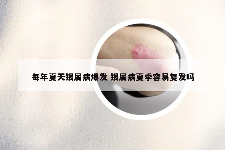 每年夏天银屑病爆发 银屑病夏季容易复发吗