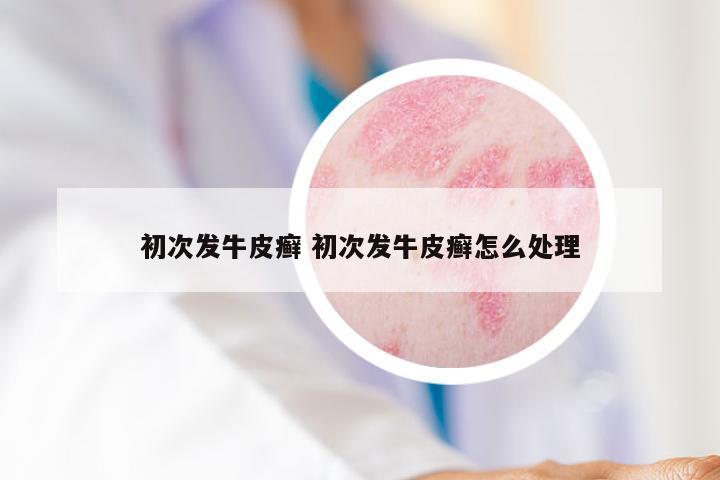 初次发牛皮癣 初次发牛皮癣怎么处理