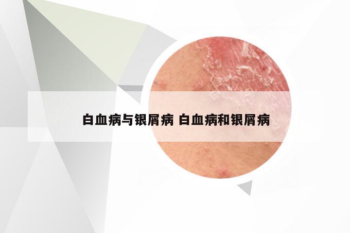 白血病与银屑病 白血病和银屑病