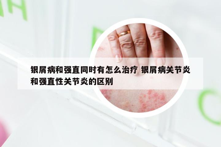 银屑病和强直同时有怎么治疗 银屑病关节炎和强直性关节炎的区别