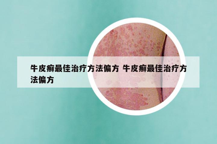 牛皮癣最佳治疗方法偏方 牛皮癣最佳治疗方法偏方