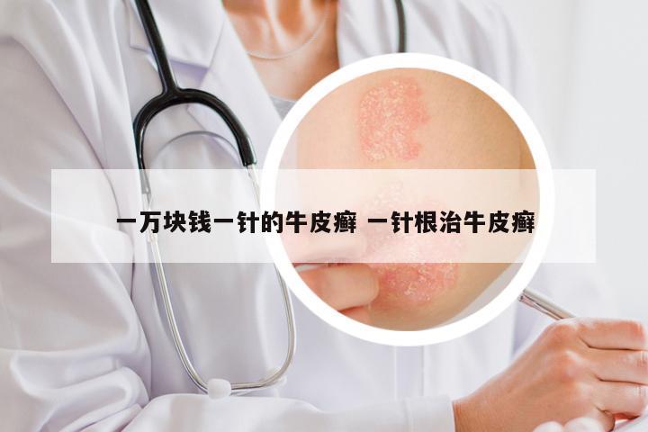 一万块钱一针的牛皮癣 一针根治牛皮癣