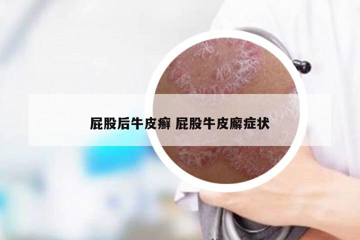 屁股后牛皮癣 屁股牛皮廨症状