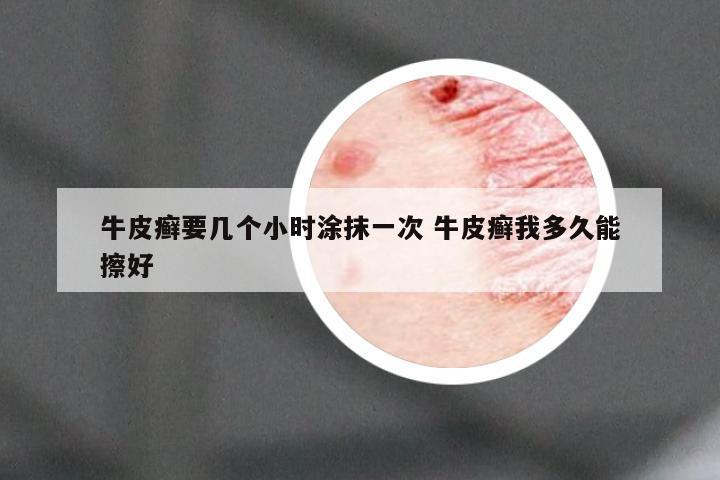 牛皮癣要几个小时涂抹一次 牛皮癣我多久能擦好