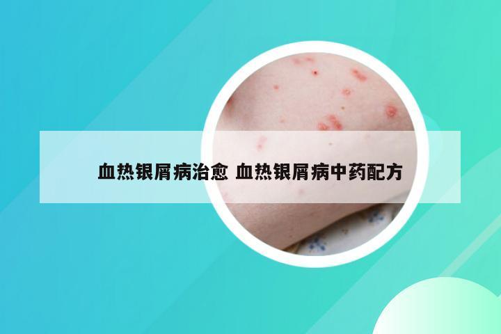 血热银屑病治愈 血热银屑病中药配方