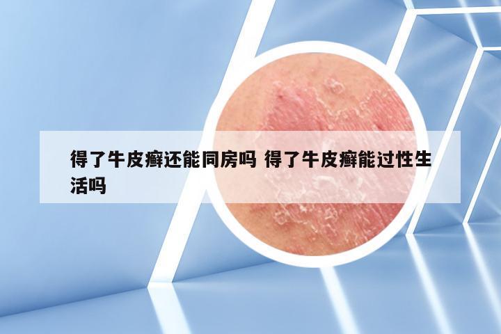 得了牛皮癣还能同房吗 得了牛皮癣能过性生活吗