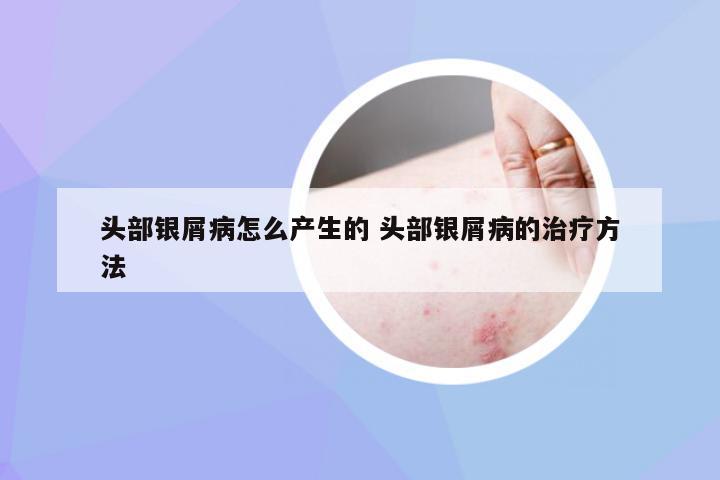 头部银屑病怎么产生的 头部银屑病的治疗方法