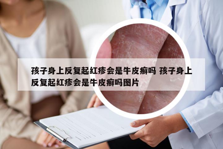 孩子身上反复起红疹会是牛皮癣吗 孩子身上反复起红疹会是牛皮癣吗图片