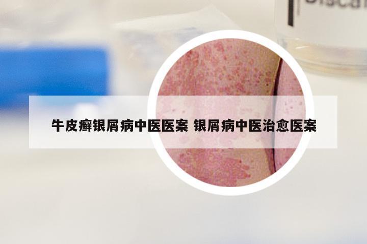 牛皮癣银屑病中医医案 银屑病中医治愈医案
