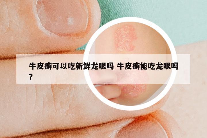 牛皮癣可以吃新鲜龙眼吗 牛皮癣能吃龙眼吗?