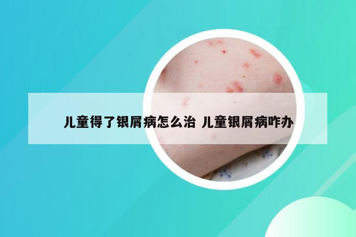 儿童得了银屑病怎么治 儿童银屑病咋办