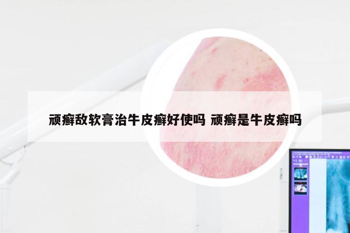 顽癣敌软膏治牛皮癣好使吗 顽癣是牛皮癣吗