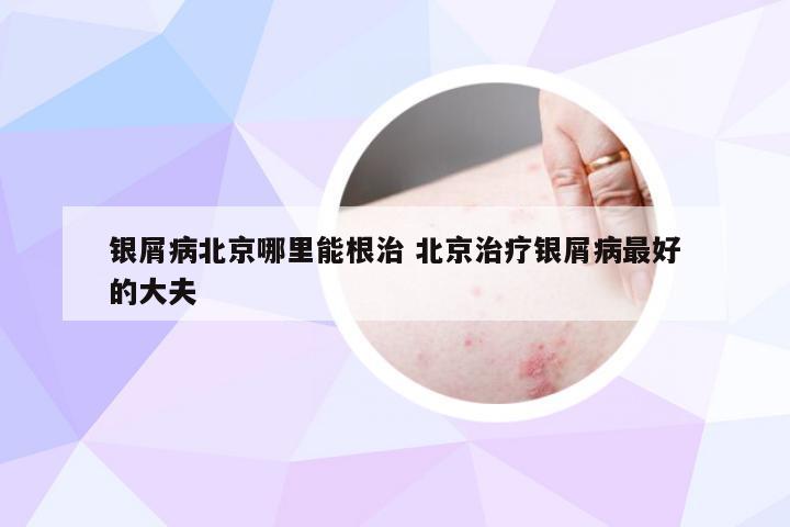 银屑病北京哪里能根治 北京治疗银屑病最好的大夫
